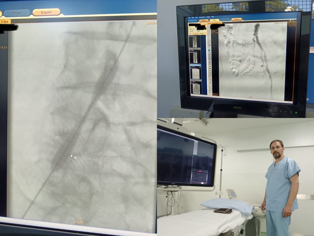 Premieră medicală la Spitalul Județean! Medicii au deblocat o arteră înfundată fără operație clasică